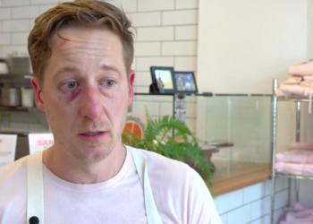 Harter with a bruised eye and forehead following the incident.