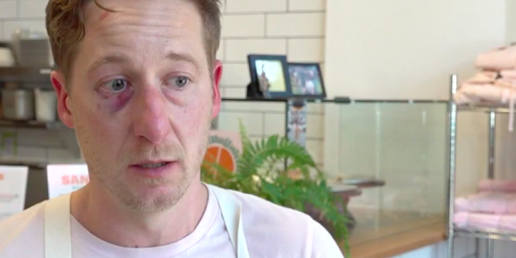 Harter with a bruised eye and forehead following the incident.