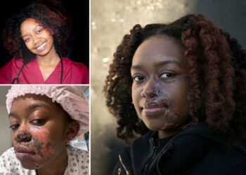 Woman burned by acid in random subway attack has 16th surgery to to fix face