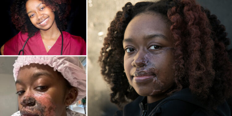 Woman burned by acid in random subway attack has 16th surgery to to fix face